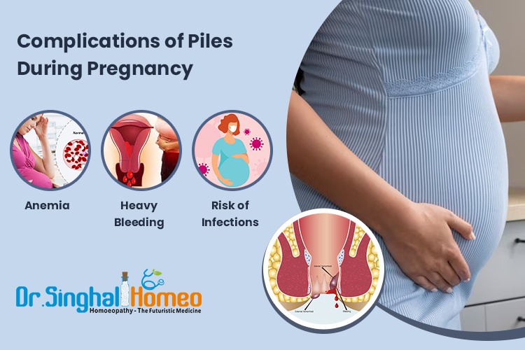 Homeopathic Medicine for Piles and Constipation